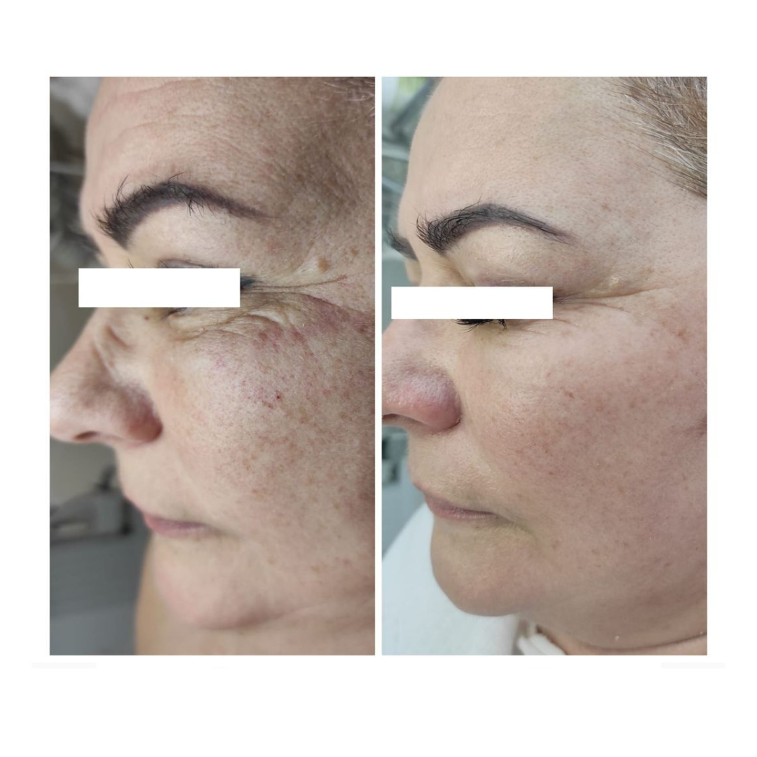Phorma Laser kezelés dokumentált eredménye