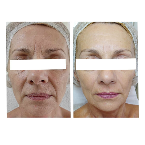 Phorma Laser kezelés előtti és utáni eredménye