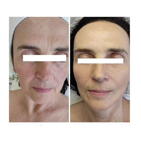 Phorma Laser kezelés előtti és utáni bőrállapot